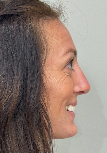 Rhinoplasty