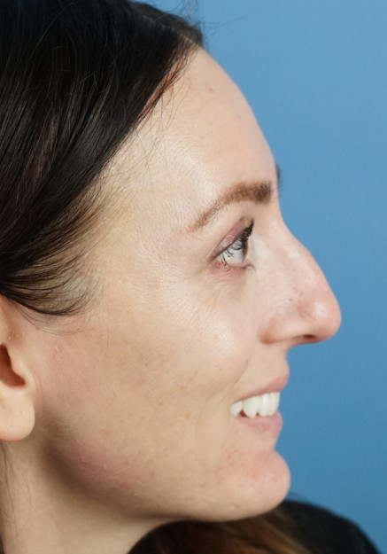 Rhinoplasty